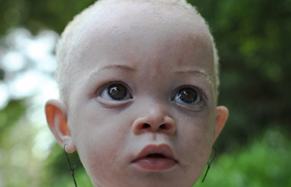 African Albino People