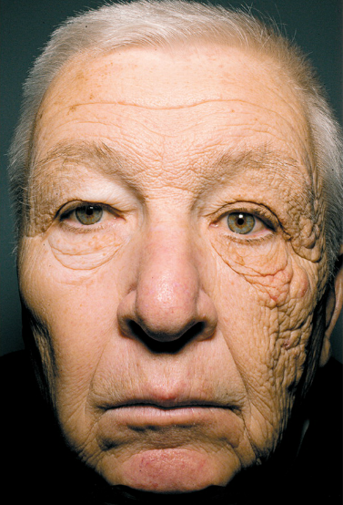 Truck Driver gets sun on one side of his face for years.