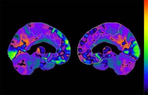 chemobrain2