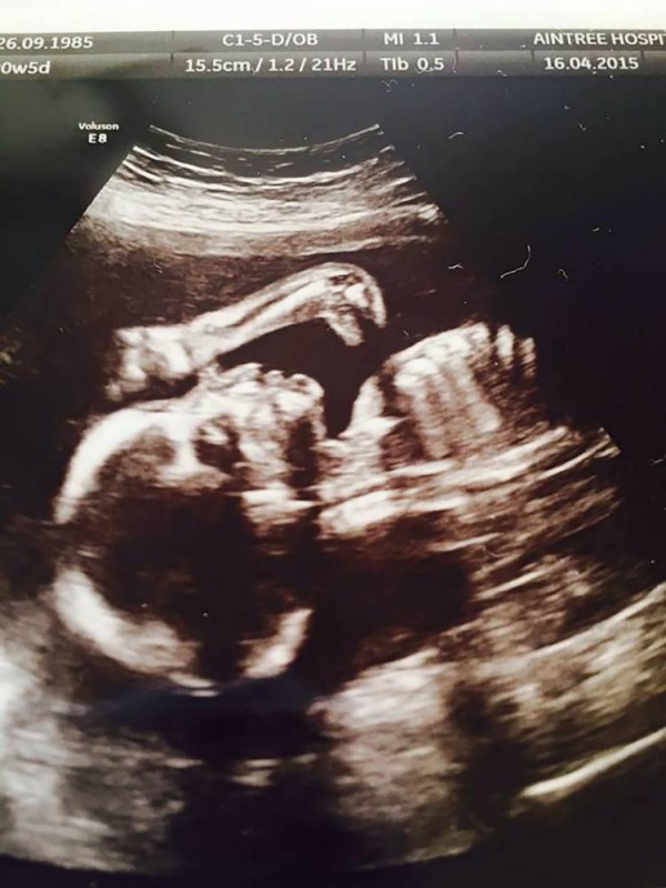 PIC FROM MERCURY PRESS (PICTURED: LEANNE SULLUVAN'S 20 WEEK BABY SCAN OF RUTHIE-LOU WHICH PECULIARLY INCLUDES A DINOSAUR) 




<p>Life will find a way. </p>
<p> <a href=